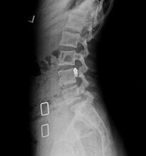 Film X Ray Or Radiograph Of A Lumbar Vertebrae Anterior Posterior AP Slightly Oblique View Showing Scotty Dog Sign, A Bone Fracture In The Pars Interarticularis, That Is, A Pars Defect Spondylolysis