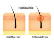 Folliculitis Science Design Vector Illustration Diagram