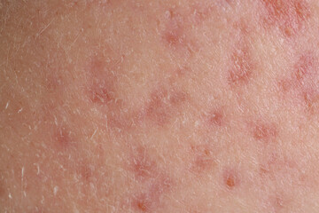 Texture of skin with acne problem as background, macro view