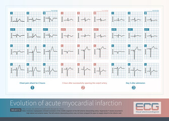 Wall Mural - Male, 65 years old, was clinically diagnosed with acute anterior myocardial infarction. The patient was treated with a coronary stent, but no reperfusion T wave occurred on day 2.