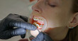 Dentist installs braces for a girl in the dental office