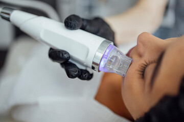 Microneedle RF lifting procedure. Hardware cosmetology.