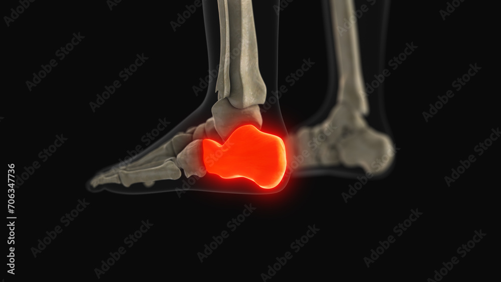 Medical animation of the calcaneus bone pain Stock Illustration | Adobe ...