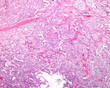 Adrenal cortex carcinoma