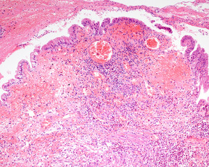 Gangrenous cholecystitis