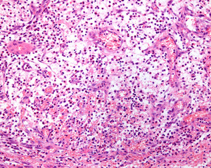 Poster - Acute inflammation