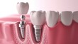prosthetics, real teeth model, modern technologies in dentistry, implant modeling