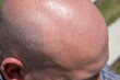 Bald man with unprotected head receiving the summer sun