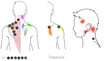 Trapezius: Myofascial trigger points and associated pain locations