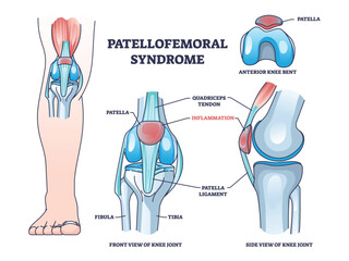 Poster - Patellofemoral pain syndrome as anatomical knee condition outline diagram. Labeled educational scheme with leg kneecap patella part inflammation vector illustration. Joint quadriceps tendon location