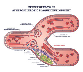 Canvas Print - Effect of flow in atherosclerotic plaque development outline diagram. Labeled educational cardiovascular condition of artery thickening or hardening issue vector illustration. Inner lining buildup.