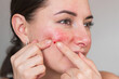 © Ольга Шефер - A young Caucasian brunette woman squeezes a pimple on her cheek until it bleeds, with tears in her eyes from the pain. Dermatology, acne, rosacea, problematic facial skin
