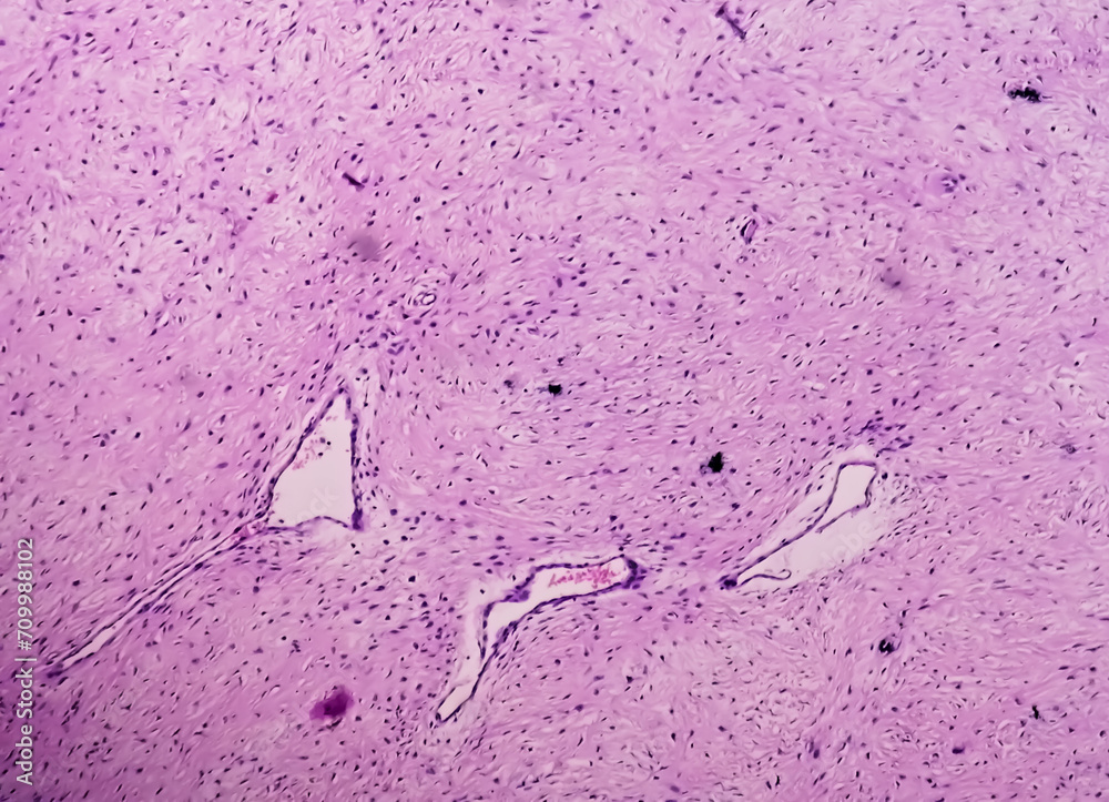 Leg tissue biopsy: Photomicrographic image showing Fibromyxoma ...