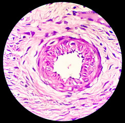 Wall Mural - Histology, Peritoneal inclusion cyst. Paraovarian cysts, hydrosalpinx and low-grade cystic mesothelioma are usually considered in the differential diagnosis of PICs.