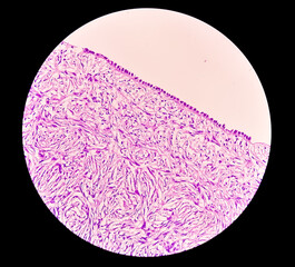 Canvas Print - Histology, Peritoneal inclusion cyst. Paraovarian cysts, hydrosalpinx and low-grade cystic mesothelioma are usually considered in the differential diagnosis of PICs.