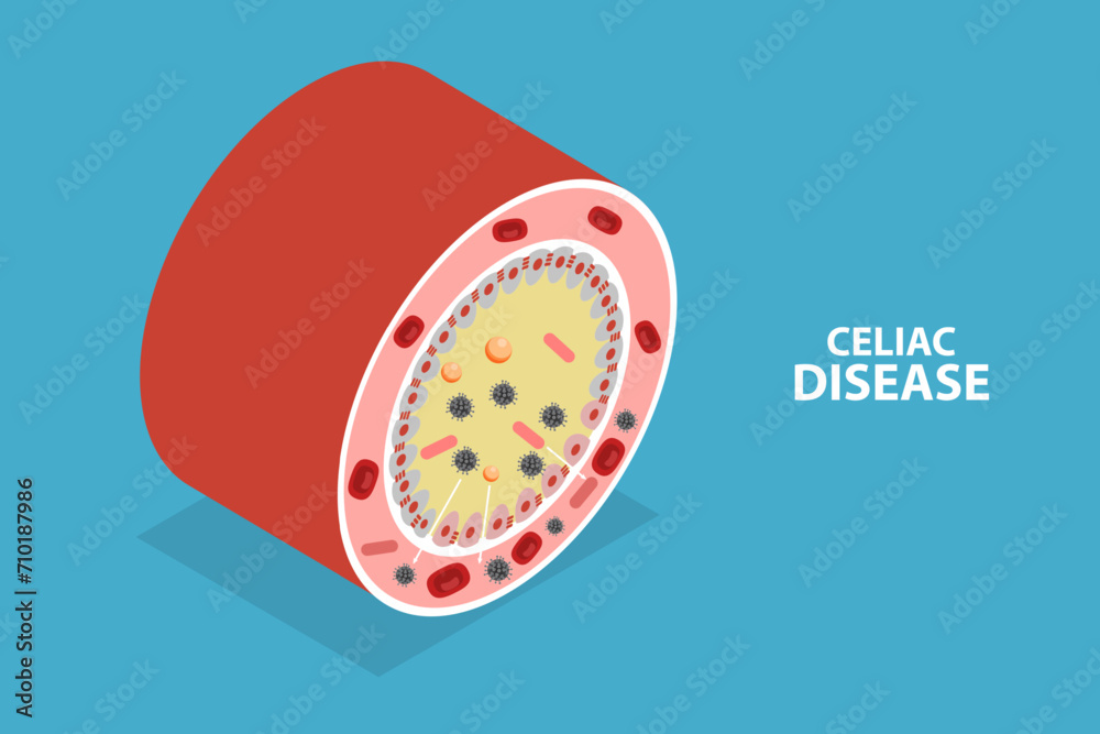 3D Isometric Flat Vector Illustration of Celiac Disease, Gluten ...