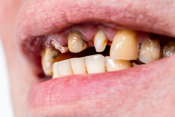 Broken tooth, missing teeth in open human mouth close up macro photo. Dental problems, dentistry medicine concept.