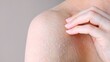 © ShantiMedia - Peeling skin close-up skin problems on shoulder scratching shoulder front view until peeling, problematic white skin effect of dermatitis and dehydration concept of peeling shoulder skin