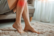 Varicosis of dilated veins on legs in a girl, leg disease
