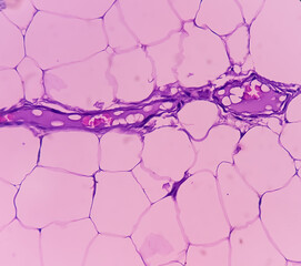 Wall Mural - Lipoma on cubital fossa, benign growth of fatty tissue, benign neoplasm, adipocytes, partially capsulated tumor, 40x microscopic view.