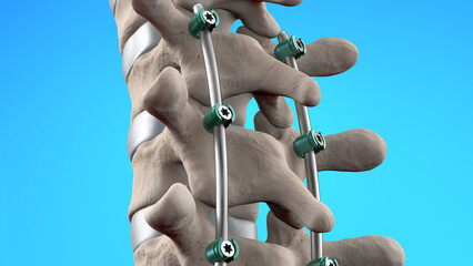 Wall Mural - Posterior Thoracic Fusion with Pedicle Screws and Rods on Light Blue Background