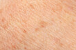 Texture of skin with pigmentation as background, macro view
