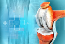Human Knee Replacement Surgery. Knee Joint Treatment. Knee Injury. 3d Illustration