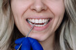 © Марина Демешко - White spot on the tooth enamel. Doctor's hand in a blue glove pointing to young blonde woman's teeth. Dental health care. Dentistry, demineralization of teeth, enamel hypoplasia, pathology, fluorosis