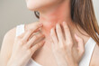 Dermatology concept, asian young woman, girl allergy, allergic reaction from atopic, insect bites on her neck, hand in scratching itchy, itch red spot or rash of skin. Health care, treatment of beauty