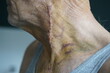 
Hematoma, bruise after carotid artery operation.
