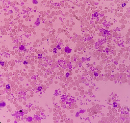 Wall Mural - Essential thrombocytosis blood smear showing abnormal high volume of platelet and White Blood Cells. Panmyelosis. Myeloprokiferative disorder.