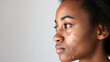 young black woman with skin problem acne on the face.