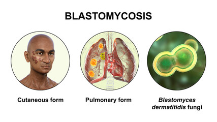 Wall Mural - Clinical forms of blastomycosis, 3D illustration