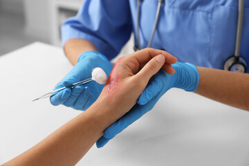 Canvas Print - Doctor treating patient's burned hand at table, closeup