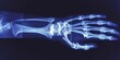 Elbow Pain X-Ray Banner, 3d Illustration of Human Arm Anatomy or Injury, Medical Cure Concept.