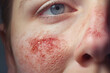 Woman with red and reddish facial rash with skin damage caused by allergy closeup. Lupus patient face needed treatment