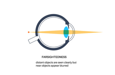 Wall Mural - Farsightedness eye disease