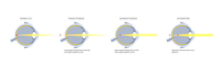 Poster - Refractive errors poster