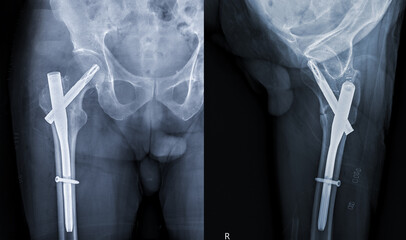 Wall Mural - An X-ray reveals both hip joints with hemiarthroplasty, showcasing the success of the surgical procedure and providing a visual testament to the restored mobility and function.