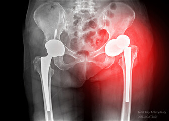 Wall Mural - An X-ray reveals both hip joints with prosthetic replacements, showcasing Dislocation of prosthetic replacements.