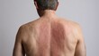 A man with a large red spot on his back