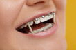 Smiling woman with dental braces and orthodontic elastics on orange background, closeup