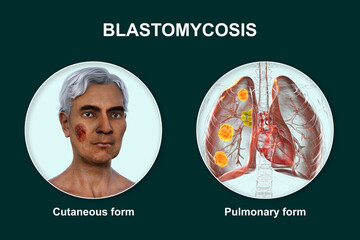 Wall Mural - Clinical forms of blastomycosis, 3D illustration