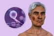 A man with cutaneous blastomycosis, 3D illustration