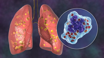 Canvas Print - Lung histoplasmosis, 3D illustration