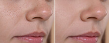Blackhead Treatment, Before And After. Collage With Photos Of Woman, Closeup View