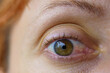 Caucasian Woman's Eye with Symptoms Similar to Pinguecula, Scleritis, Ocular Surface Squamous Neoplasia (OSSN)