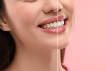 Poster - Woman showing teeth before and after whitening on pink background, collage