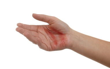 Wall Mural - Woman with burned hand on white background, closeup