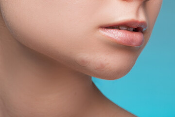 girl with acne stick round acne patch on her cheek. using acne patches for treatment of pimple and r